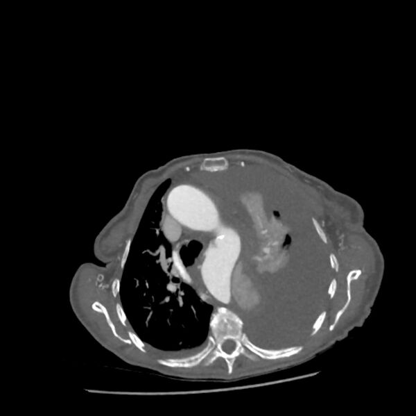 File:Aortic dissection (Radiopaedia 68763-78691 A 16).jpeg