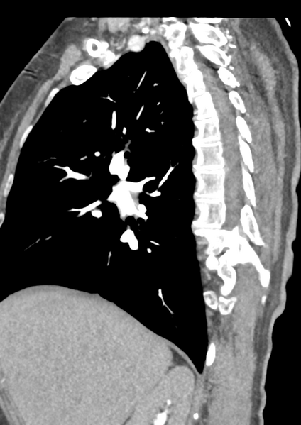 File:Aortic dissection - Stanford type B (Radiopaedia 50171-55512 C 46).png