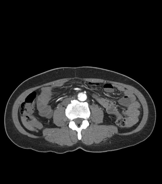 File:Aortic dissection with renal ischemia (Radiopaedia 76573-88338 A 81).jpg