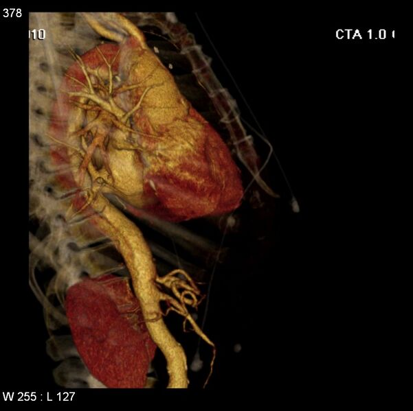 File:Aortic dissection with rupture into pericardium (Radiopaedia 12384-12647 C+ arterial phase 10).jpg