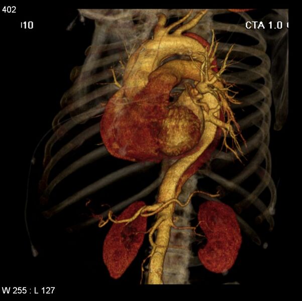File:Aortic dissection with rupture into pericardium (Radiopaedia 12384-12647 C+ arterial phase 34).jpg