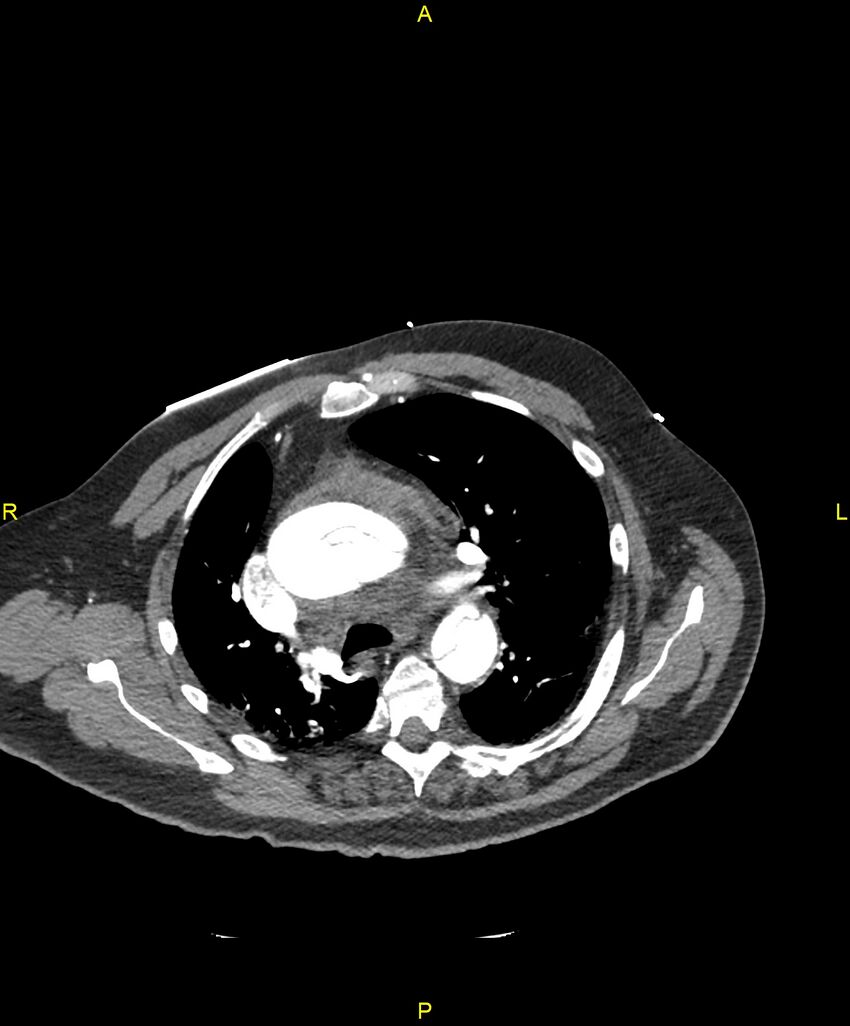 Aortic rupture (Radiopaedia 88822-105594 B 84).jpg