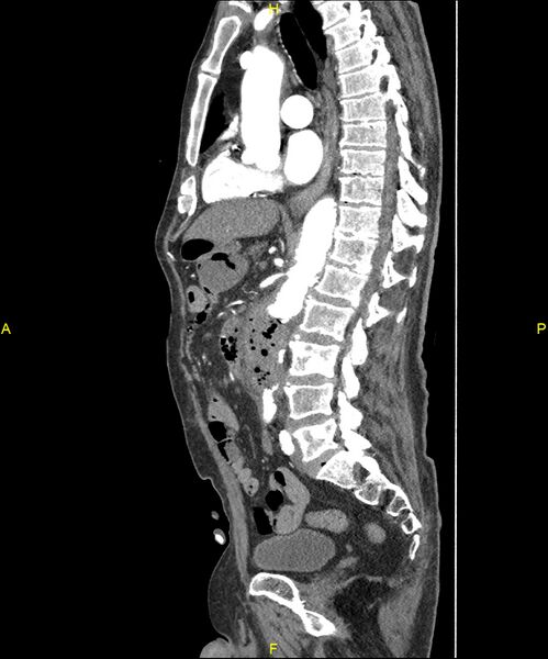 File:Aortoenteric fistula (Radiopaedia 84308-99603 C 182).jpg