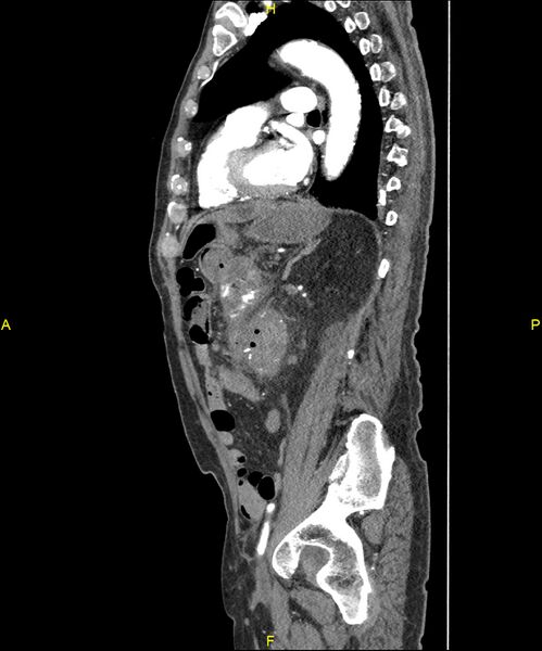 File:Aortoenteric fistula (Radiopaedia 84308-99603 C 221).jpg