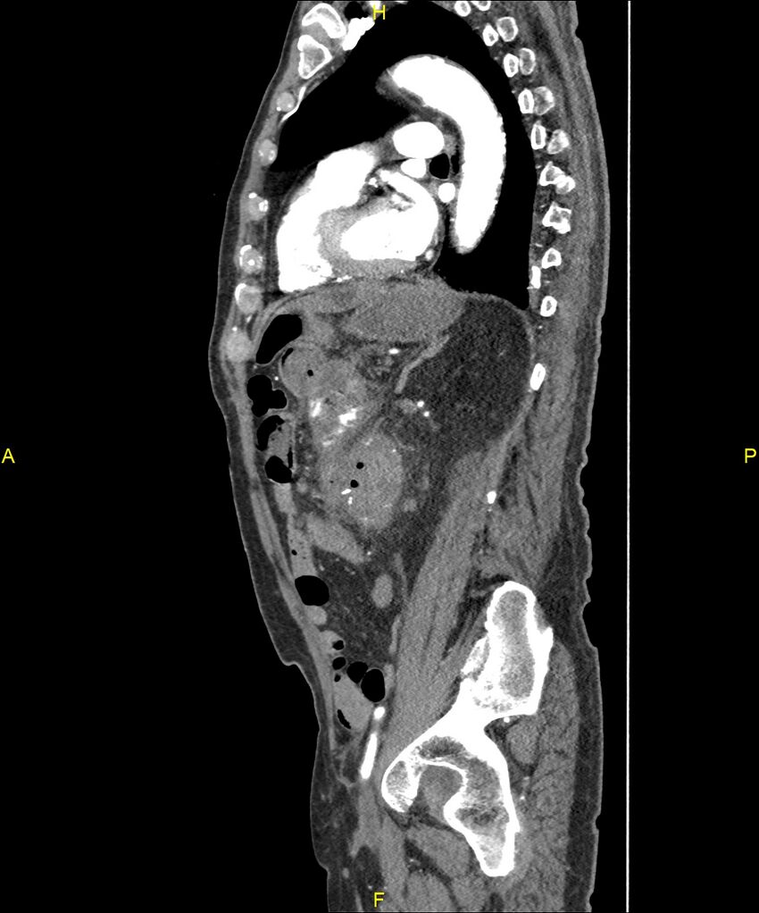 Aortoenteric fistula (Radiopaedia 84308-99603 C 221).jpg