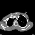 Aortopulmonary window, interrupted aortic arch and large PDA giving the descending aorta (Radiopaedia 35573-37074 B 16).jpg