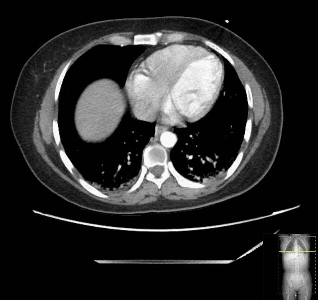 File:Appendicitis (CT angiogram) (Radiopaedia 154713-127660 Axial 183).jpg
