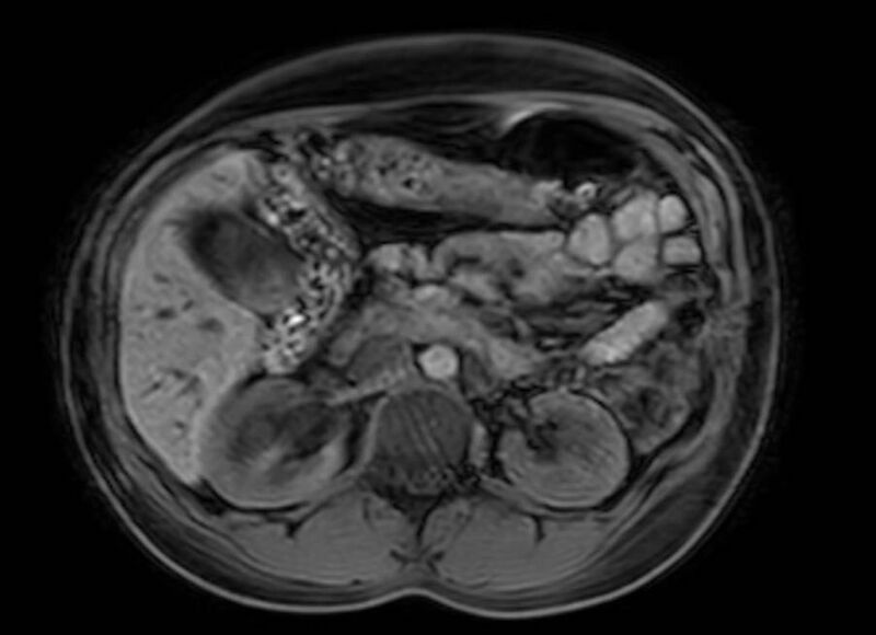 File:Appendicitis in gravida (MRI) (Radiopaedia 89433-106395 Axial DIXON 48).jpg