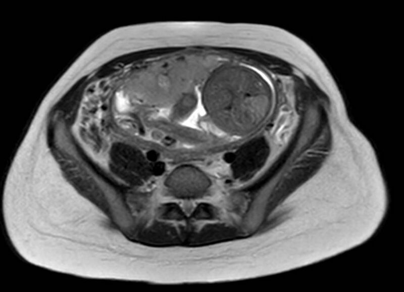 File:Appendicitis in gravida (MRI) (Radiopaedia 89433-106395 Axial T2 48).jpg