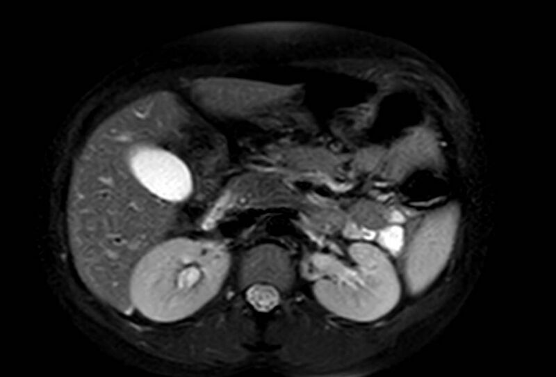 File:Appendicitis in gravida (MRI) (Radiopaedia 89433-106395 Axial T2 SPAIR 26).jpg