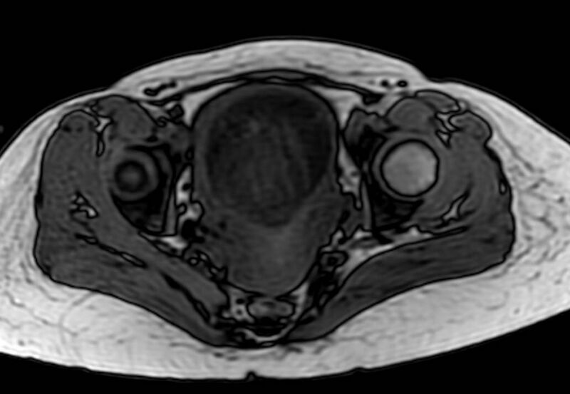 File:Appendicitis in gravida (MRI) (Radiopaedia 89433-106395 D 63).jpg