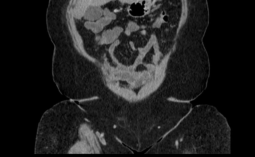 Appendix mucocele (Radiopaedia 41222-44033 B 2).jpg