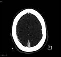 Arteriovenous malformation - cerebral (Radiopaedia 8172-14682 A 14).jpg