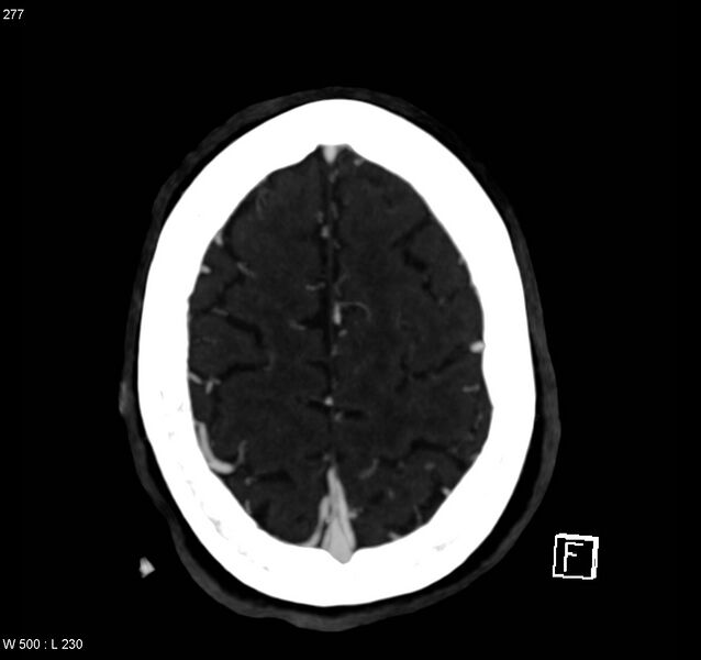 File:Arteriovenous malformation - cerebral (Radiopaedia 8172-14682 A 14).jpg