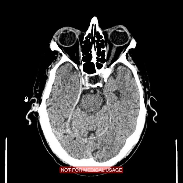 File:Artery of Percheron infarction (Radiopaedia 28679-28967 Axial non-contrast 41).jpg