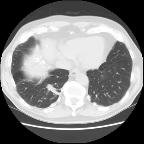 File:Asbestos-related pleural plaques (Radiopaedia 39069-41255 Axial lung window 56).jpg