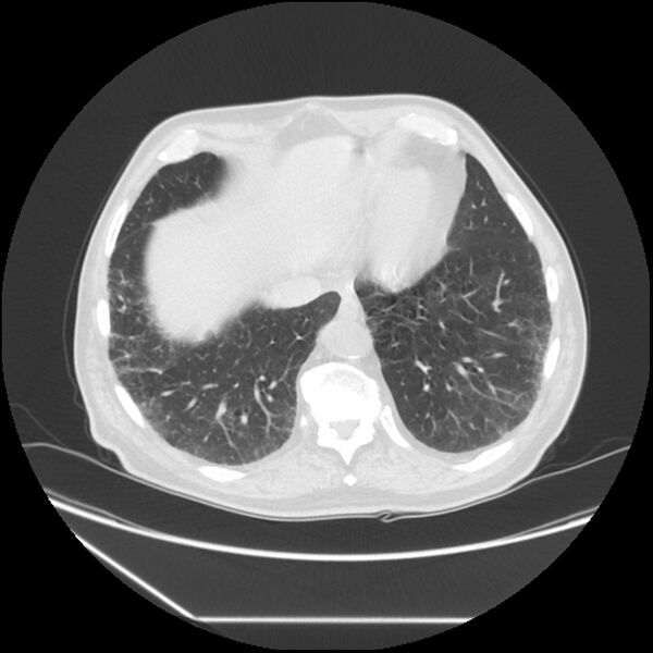 File:Asbestosis complicated by lung cancer (Radiopaedia 45834-50116 Axial lung window 54).jpg