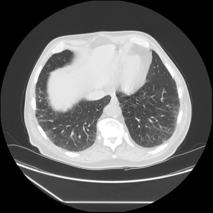 Asbestosis complicated by lung cancer (Radiopaedia 45834-50116 Axial lung window 54).jpg