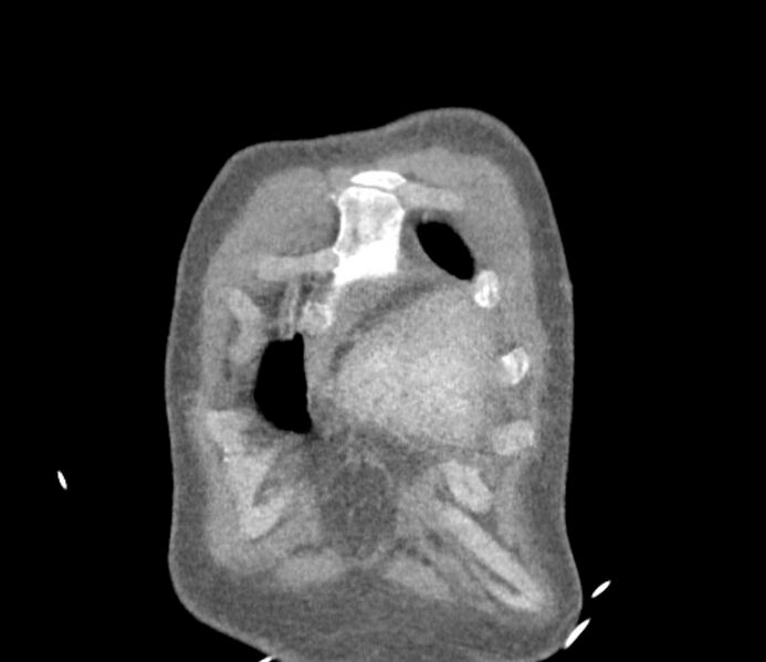 File:Ascending aortic aneurysm (Radiopaedia 86279-102297 B 1).jpg
