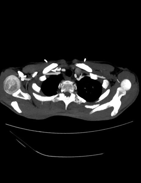 File:Ascending aortic pseudoaneurysm (Radiopaedia 28638-28910 A 1).jpg