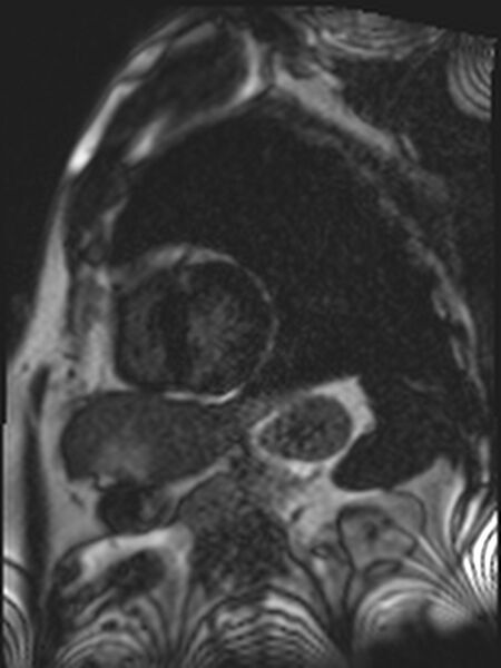 File:Asymmetric septal hypertrophic cardiomyopathy - systolic anterior motion of mitral leaflet (Radiopaedia 72795-83445 D 6).jpg
