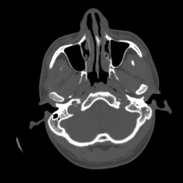 File:Asymptomatic occipital spur (Radiopaedia 87753-104201 Axial bone window 17).jpg
