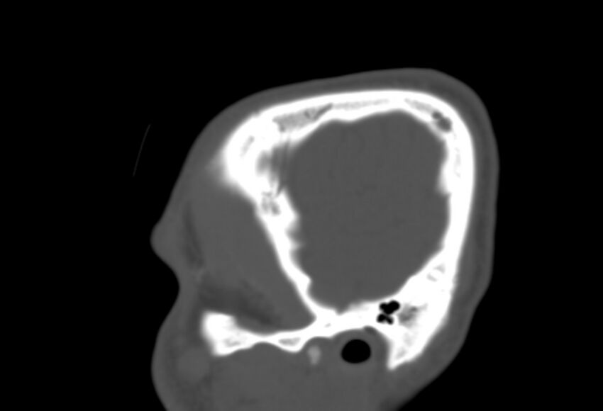Asymptomatic occipital spur (Radiopaedia 87753-104201 Sagittal bone window 19).jpg