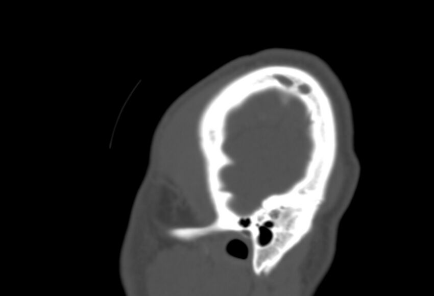 Asymptomatic occipital spur (Radiopaedia 87753-104201 Sagittal bone window 298).jpg