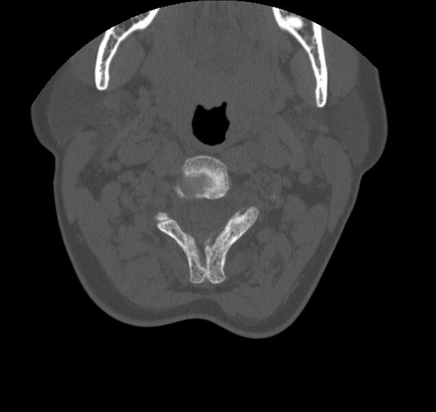 File:Atlanto-occipital assimilation with basilar invagination (Radiopaedia 70122-80188 Axial bone window 51).jpg