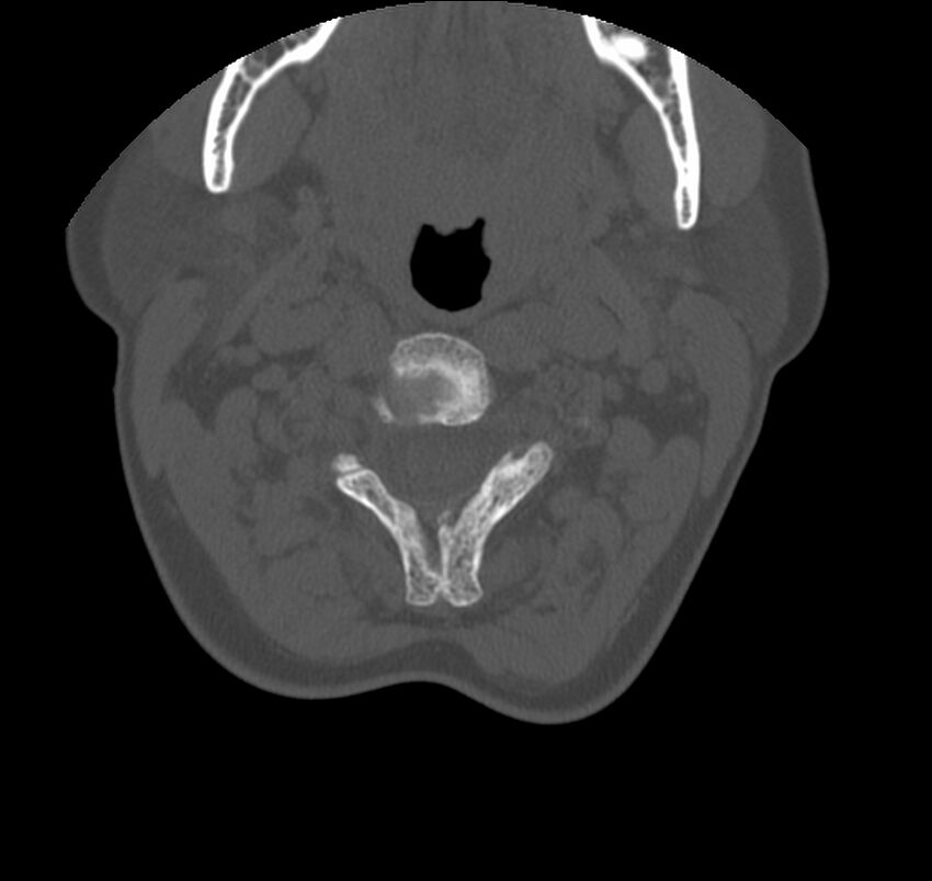 Atlanto-occipital assimilation with basilar invagination (Radiopaedia 70122-80188 Axial bone window 51).jpg