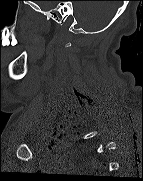 File:Atlanto-occipital dissociation - Traynelis type 1 (Radiopaedia 87570-103948 Sagittal bone window 28).jpg