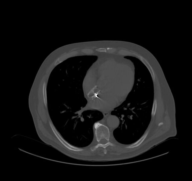 File:Atrial septal defect closure device (Radiopaedia 28295-28536 Axial CT Bone Window 1).jpg