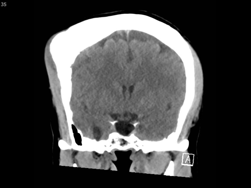 Atypical meningioma - intraosseous (Radiopaedia 64915-73867 B 34).jpg