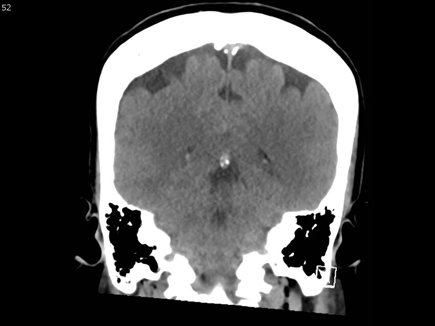 Atypical meningioma - intraosseous (Radiopaedia 64915-73867 B 51).jpg