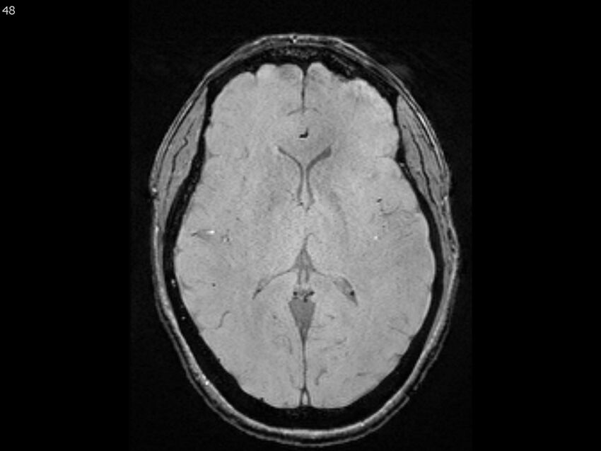 Atypical meningioma - intraosseous (Radiopaedia 64915-74572 Axial SWI 48).jpg