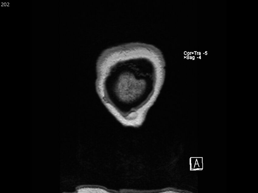 Atypical meningioma - intraosseous (Radiopaedia 64915-74572 Coronal T1 202).jpg