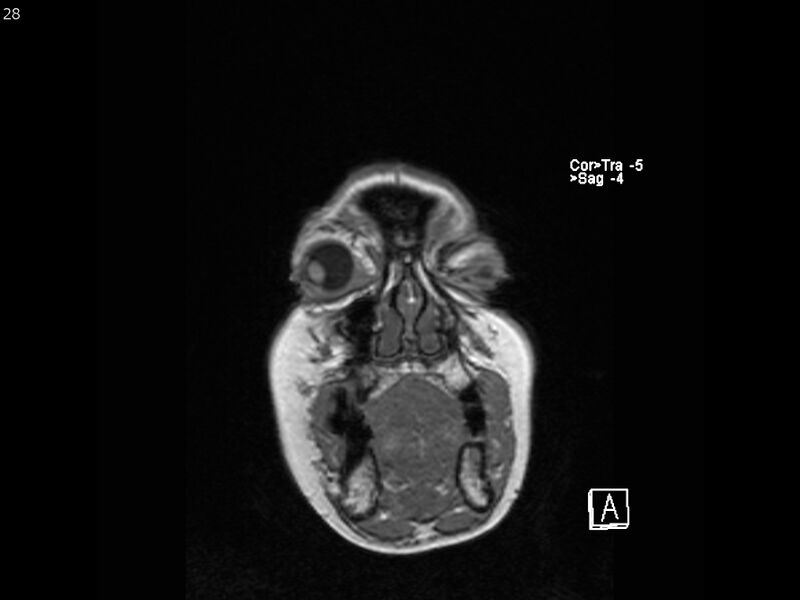 File:Atypical meningioma - intraosseous (Radiopaedia 64915-74572 Coronal T1 28).jpg