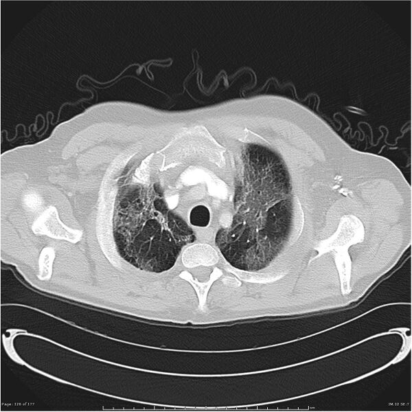 File:Atypical pneumonia - Q fever (Radiopaedia 21993-21989 lung window 5).jpg