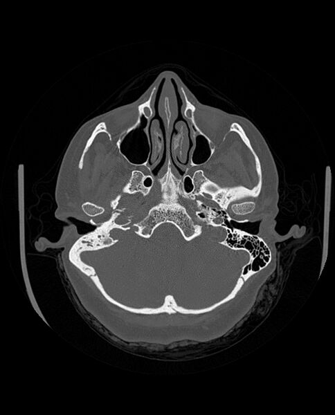 File:Automastoidectomy with labyrinthine fistula (Radiopaedia 84143-99411 Axial non-contrast 74).jpg
