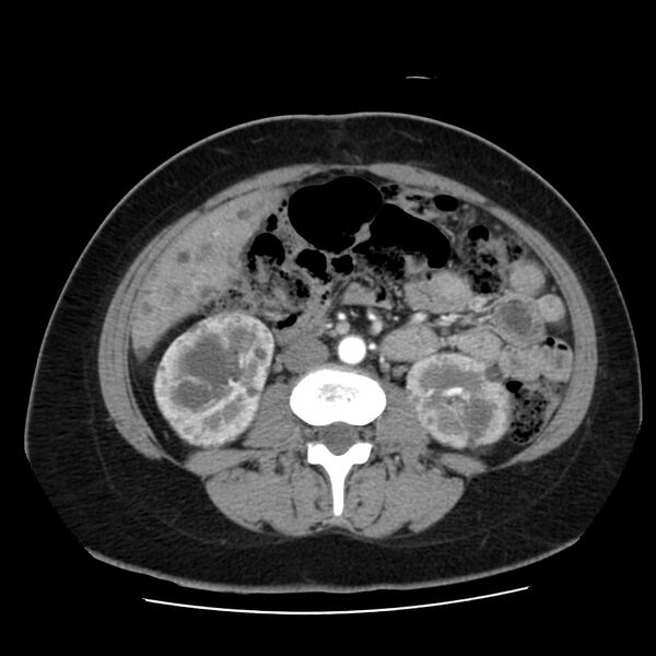 File:Autosomal dominant polycystic kidney disease (Radiopaedia 23061-23093 B 36).jpg