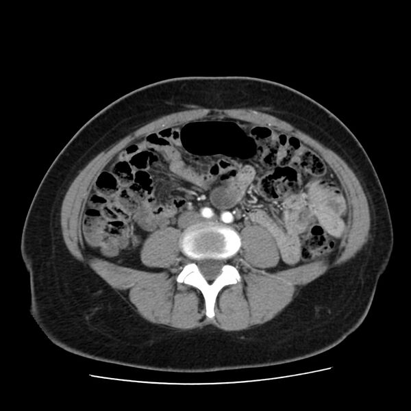File:Autosomal dominant polycystic kidney disease (Radiopaedia 23061-23093 B 43).jpg