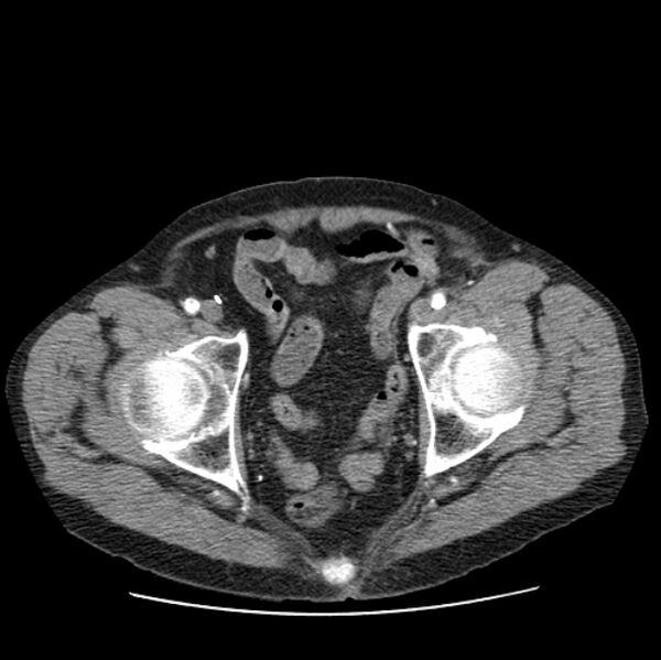 File:Autosomal dominant polycystic kidney disease (Radiopaedia 27851-28094 B 113).jpg