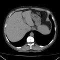 Autosomal dominant polycystic kidney disease (Radiopaedia 36539-38101 Axial non-contrast 15).jpg