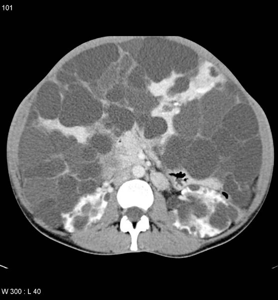 File:Autosomal dominant polycystic kidney disease with extensive hepatic involvement (Radiopaedia 5204-6971 B 13).jpg