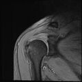 Avulsion fracture - greater tuberosity of humerus (Radiopaedia 71216-81515 Coronal T2 12).jpg