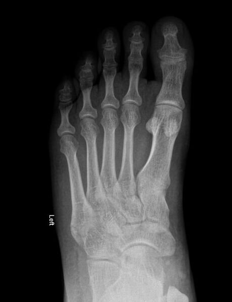 File:Avulsion fracture of the 5th metatarsal styloid - pseudo-Jones fracture (Radiopaedia 64009-72761 Frontal 1).JPG