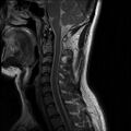 Axis fracture - MRI (Radiopaedia 71925-82375 Sagittal T2 5).jpg