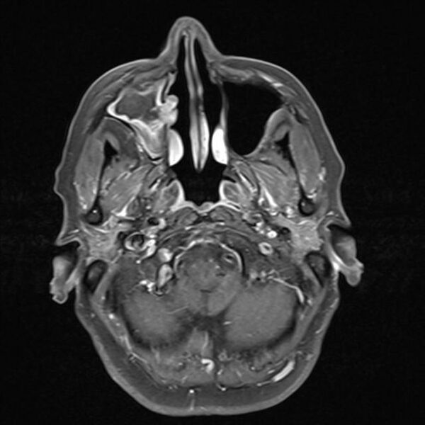File:Base of skull chondrosarcoma (Radiopaedia 30410-31070 Axial T1 C+ fat sat 4).jpg