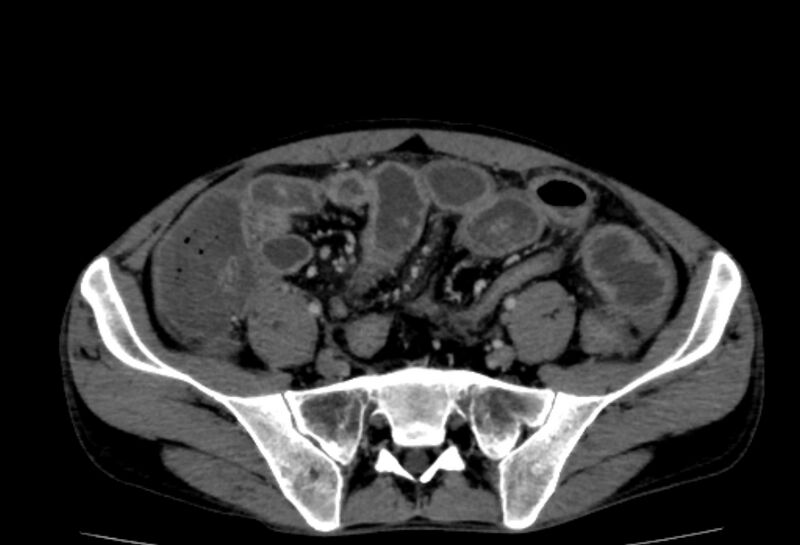 File:Behçet's disease. abdominal vasculitis (Radiopaedia 55955-62570 Axial 26).jpg