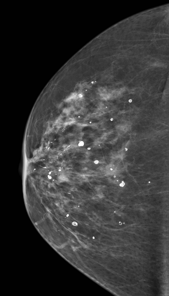 File:Benign breast calcifications (Radiopaedia 18962).png